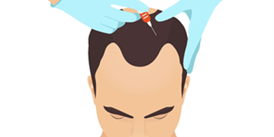 Haarproblemen? Kijk wat Dr. Don voor u kan doen