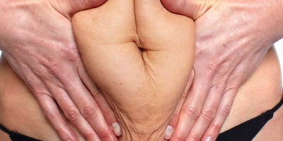 Mislukte liposuctie buik: Herstel en verbetering bij Clinique Dr. Don