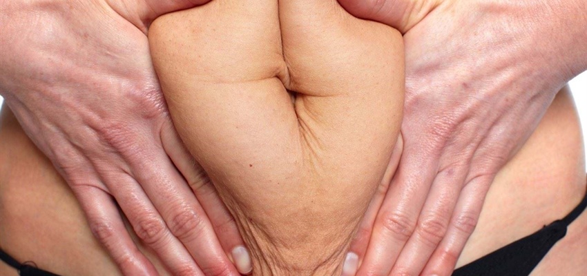 Mislukte liposuctie buik: Herstel en verbetering bij Clinique Dr. Don