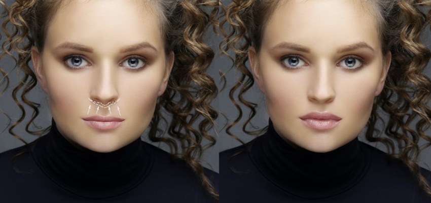 Neus lippenplooi verminderen: Alles wat u moet weten voor een jeugdige uitstraling