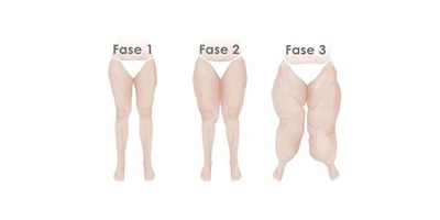 Lipoedeem, wat is dat en hoe herken je het?