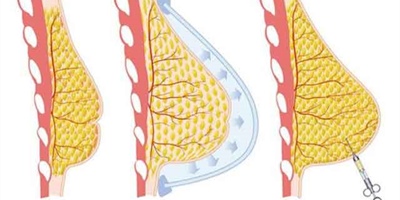 Ik wil graag borstvergroting, kan dit met eigen vet?