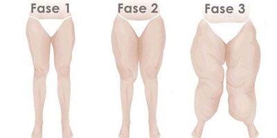 Ik heb de aandoening Lipoedeem en wil graag liposuctie, zijn deze kosten aftrekbaar bij de belasting?