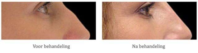 Neus behandelen met Fillers - voor en na behandeling