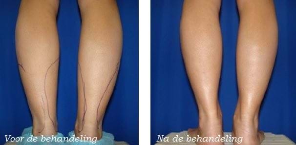 liposuctie enkels voor en na