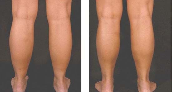 liposuctie enkels voor en na