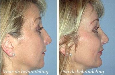 liposuctie voor en na wangen 