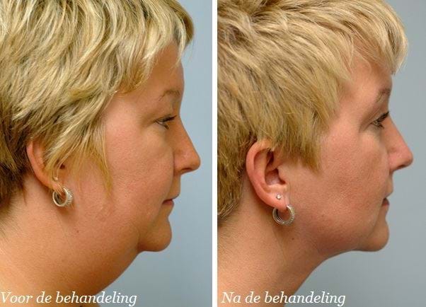 liposuctie voor en na wangen 