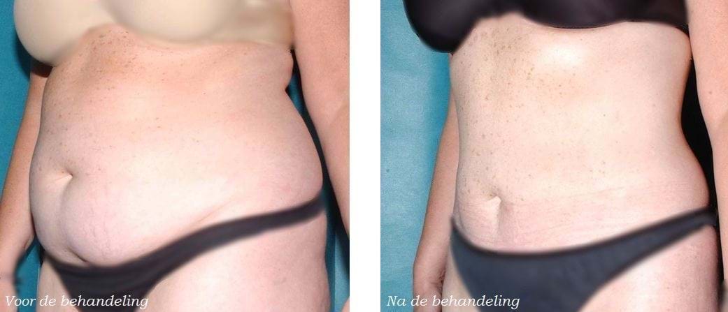 liposuctie buik voor en na 